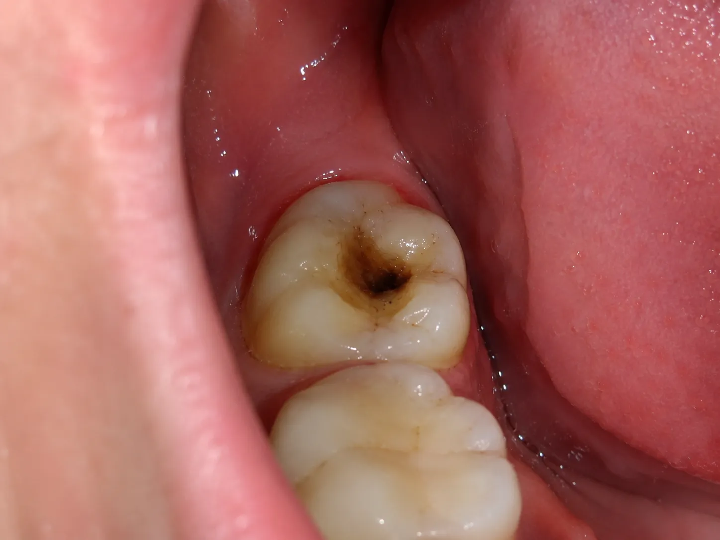 Before – chipped or discoloured tooth